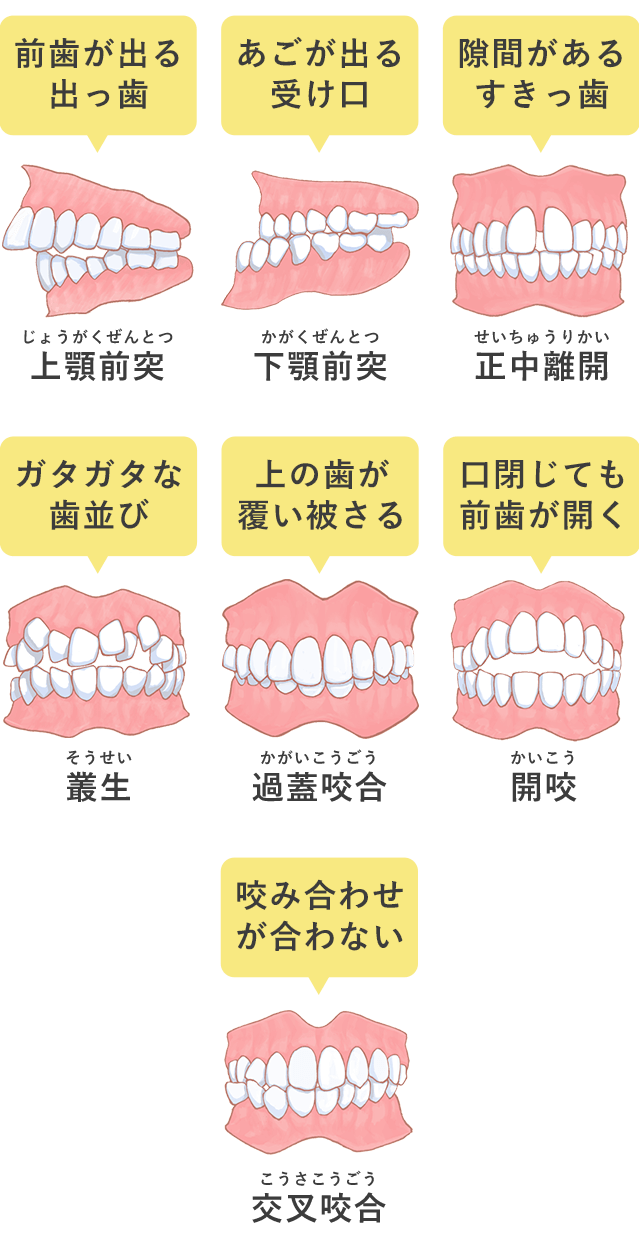 矯正治療が必要な歯並び